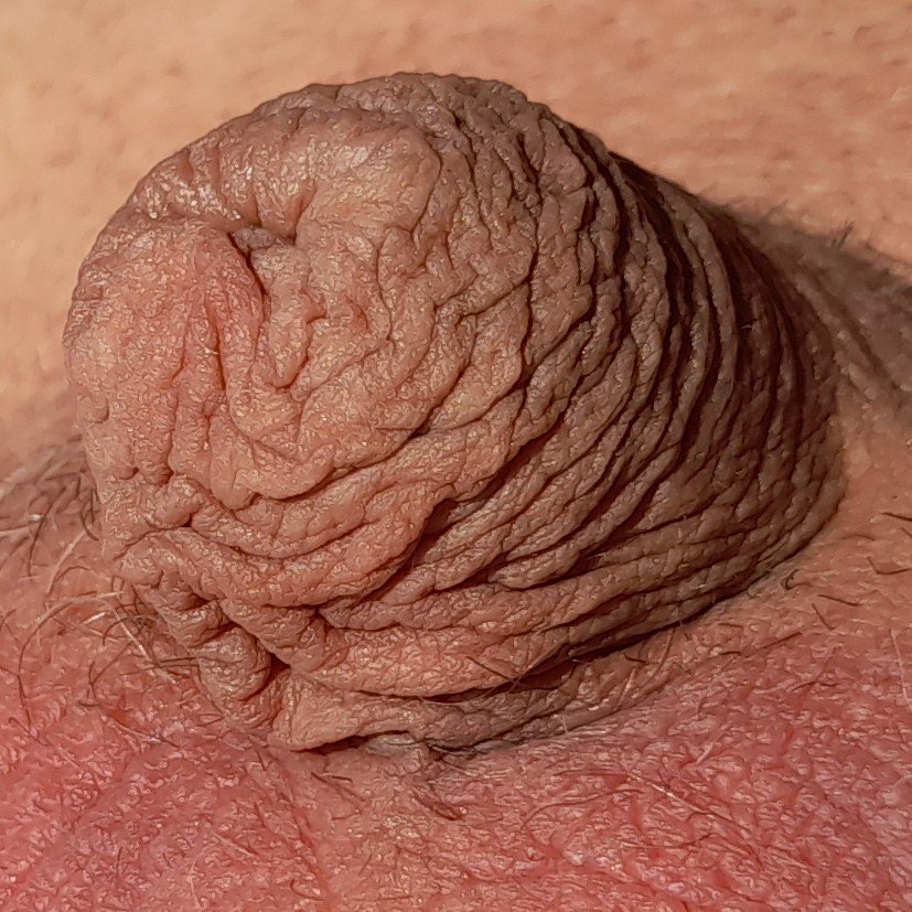 little sexe #OpOtInDx